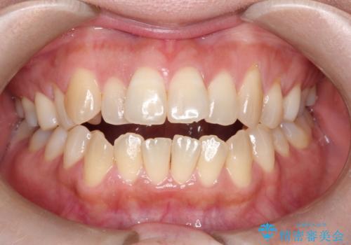 【開咬】笑った時の見た目を改善したい。の症例 治療前