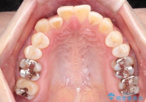 【開咬】笑った時の見た目を改善したい。の治療前