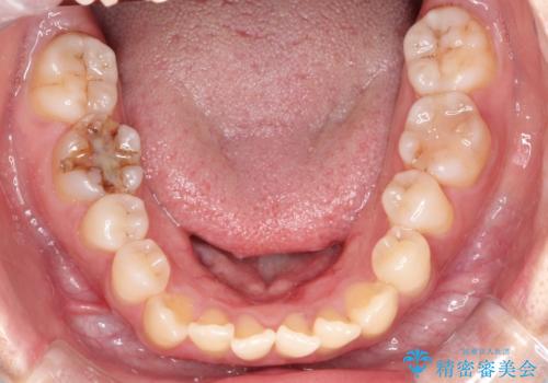 【開咬】笑った時の見た目を改善したい。の治療前