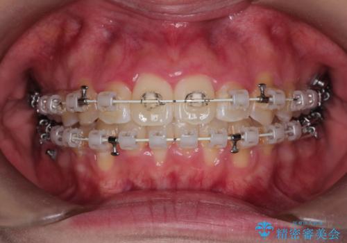 【審美装置】前歯のがたがたを治したい。の治療中