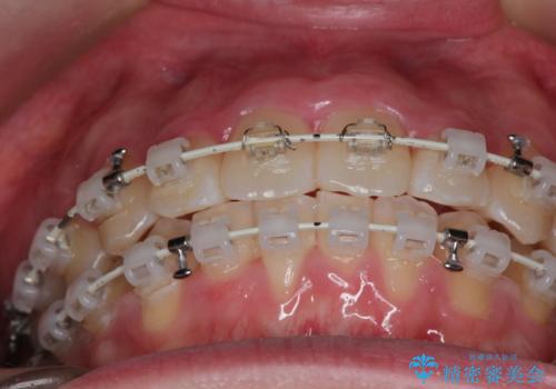 【審美装置】前歯のがたがたを治したい。の治療中