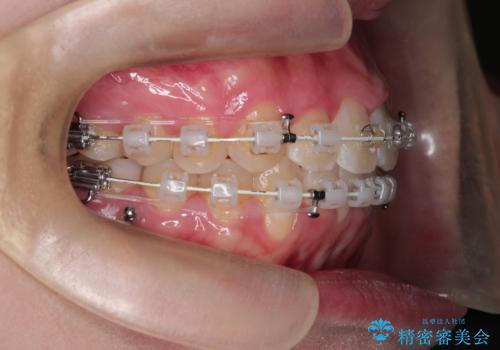 【審美装置】前歯のがたがたを治したい。の治療中