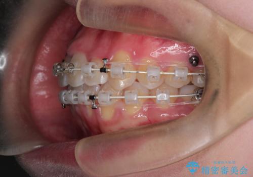 【審美装置】前歯のがたがたを治したい。の治療中