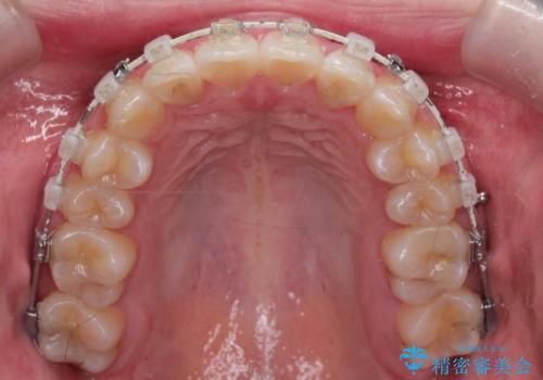 【審美装置】前歯のがたがたを治したい。の治療中