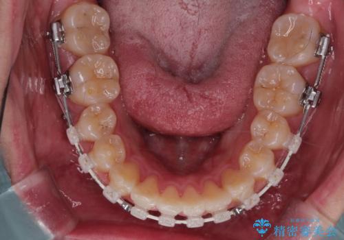 【審美装置】前歯のがたがたを治したい。の治療中