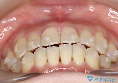 【開咬】笑った時の見た目を改善したい。の治療中