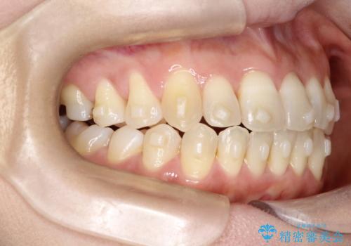 【開咬】笑った時の見た目を改善したい。の治療中