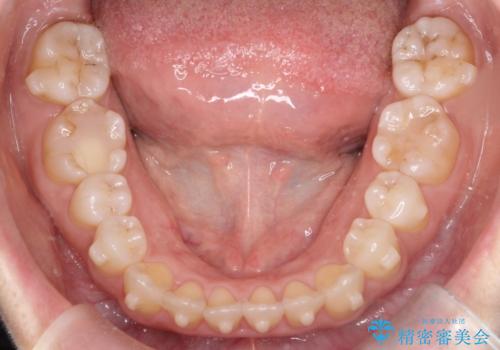 【開咬】笑った時の見た目を改善したい。の治療中