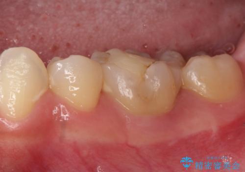 【セラミッククラウン】適合の悪いアンレーのやり替えの治療前