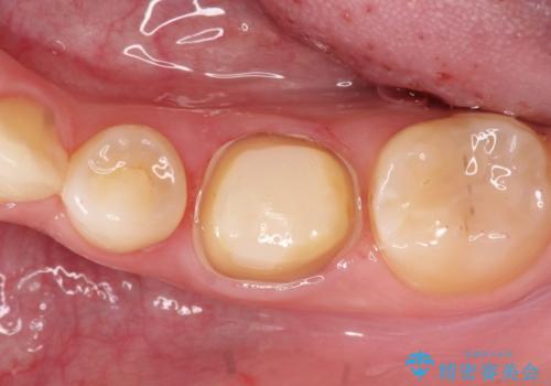 【セラミッククラウン】適合の悪いアンレーのやり替えの治療中