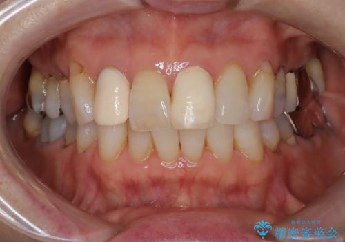 【外傷歯】根管治療から被せ物まで。の治療前