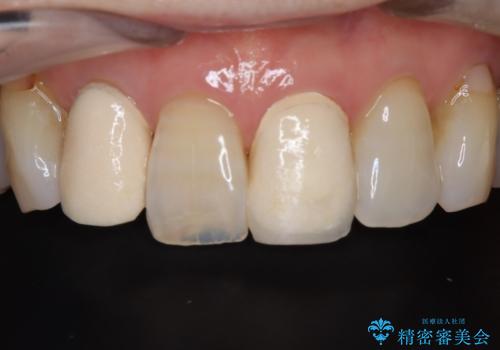 【外傷歯】根管治療から被せ物まで。の症例 治療前