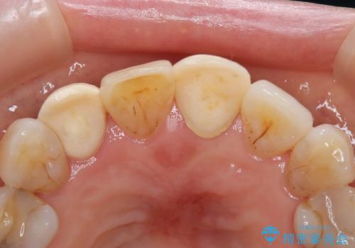 【外傷歯】根管治療から被せ物まで。の治療前