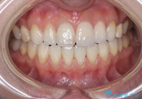 【オールセラミッククラウン】前歯の色が気になる! 左右で歯の長さが違うの治療後