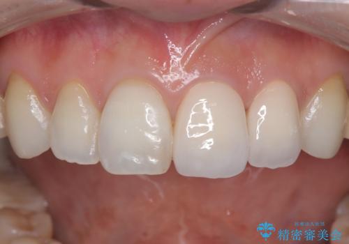 【オールセラミッククラウン】前歯の色が気になる! 左右で歯の長さが違うの治療後