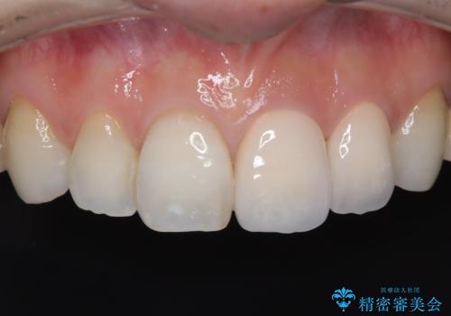 【オールセラミッククラウン】前歯の色が気になる! 左右で歯の長さが違うの症例 治療後