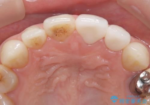 【オールセラミッククラウン】前歯の色が気になる! 左右で歯の長さが違うの治療後