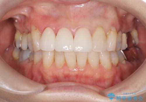 【外傷歯】根管治療から被せ物まで。の治療後