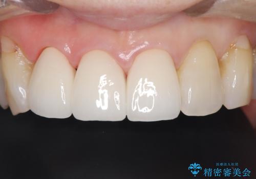 【外傷歯】根管治療から被せ物まで。の症例 治療後