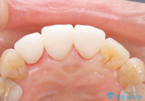 【外傷歯】根管治療から被せ物まで。の治療後