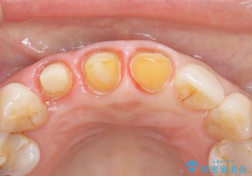 【外傷歯】根管治療から被せ物まで。の治療中