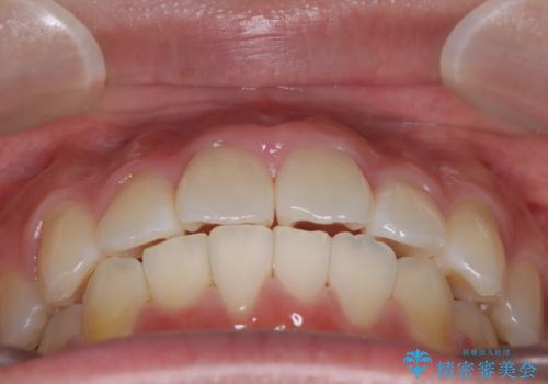 【審美装置】前歯のがたがたを治したい。の治療後