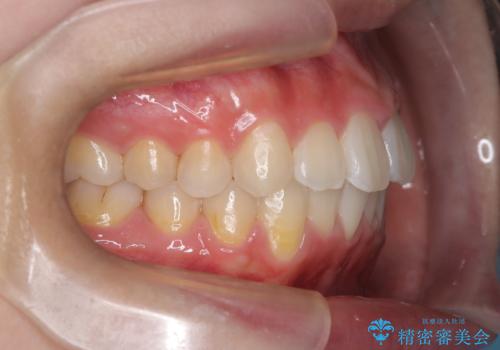 【審美装置】前歯のがたがたを治したい。の治療後