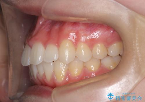 【審美装置】前歯のがたがたを治したい。の治療後