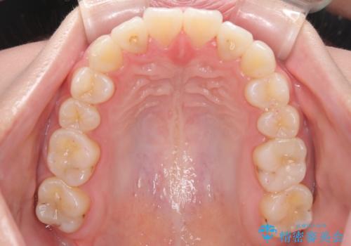 【審美装置】前歯のがたがたを治したい。の治療後