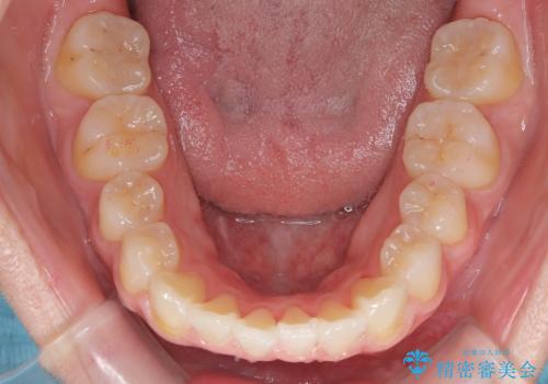 【審美装置】前歯のがたがたを治したい。の治療後