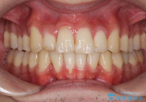 【インビザライン】マウスピース矯正希望。の治療後