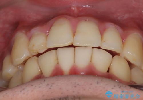 【インビザライン】マウスピース矯正希望。の治療後