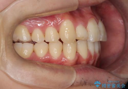【インビザライン】マウスピース矯正希望。の治療後