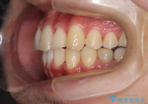 【インビザライン】マウスピース矯正希望。の治療後