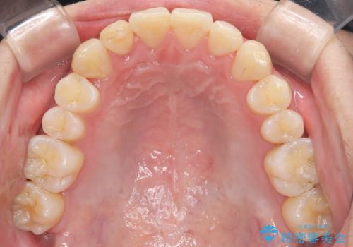 【インビザライン】マウスピース矯正希望。の治療後