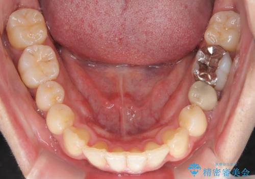 【インビザライン】マウスピース矯正希望。の治療後