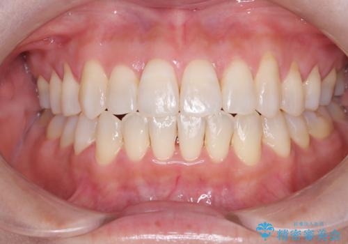 【開咬】笑った時の見た目を改善したい。の症例 治療後