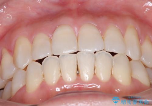 【開咬】笑った時の見た目を改善したい。の治療後