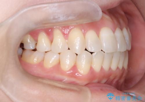 【開咬】笑った時の見た目を改善したい。の治療後
