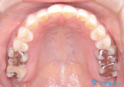【開咬】笑った時の見た目を改善したい。の治療後