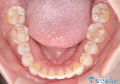 【開咬】笑った時の見た目を改善したい。の治療後