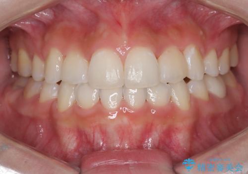 【ハーフリンガル】重度の叢生の治療後