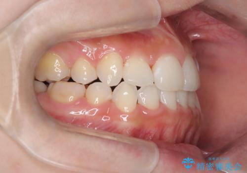 【ハーフリンガル】重度の叢生の治療後