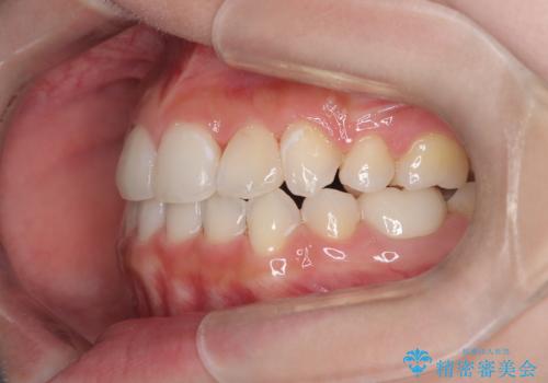 【ハーフリンガル】重度の叢生の治療後