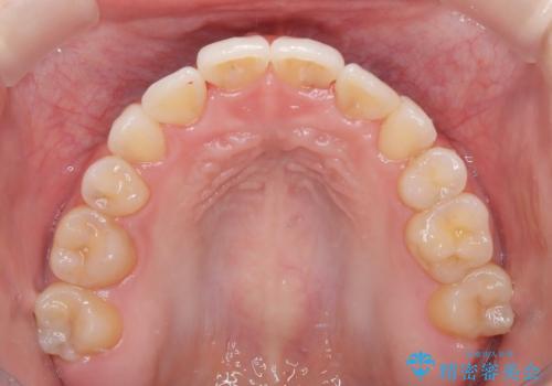 【ハーフリンガル】重度の叢生の治療後