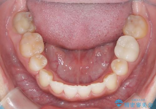 【ハーフリンガル】重度の叢生の治療後