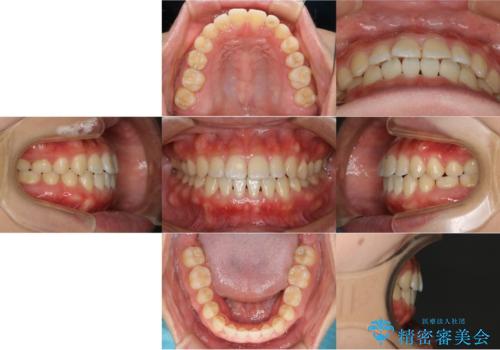 歯茎が薄い方へのインビザライン治療、歯肉退縮予防の治療後