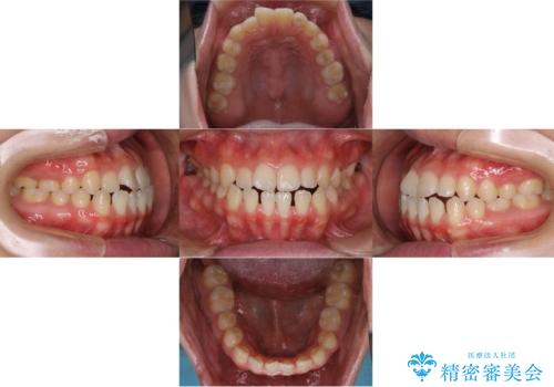 歯茎が薄い方へのインビザライン治療、歯肉退縮予防の治療前
