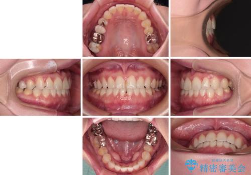 前歯のデコボコをすっきりと インビザライン矯正の治療前