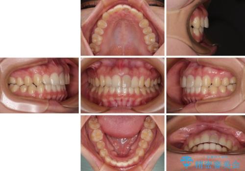 飛び出した上顎前歯 インビザラインで引っ込めるの治療後